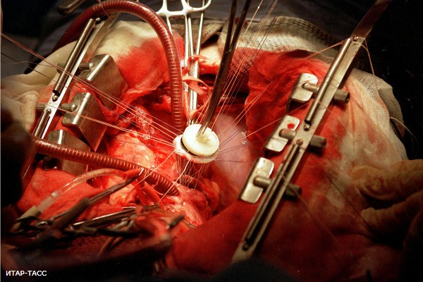 Роботы делают операции на сердце