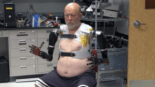 double-amputee-mind-controlled-prosthetics-0